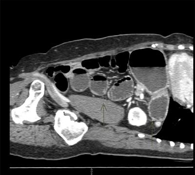 Takotsubo Syndrome (TTS) in Onco-Hematologic Patients: Retrospective Analysis and Focus on the Correlation or Not With Anticancer Drugs. Case Reports and Review of the Literature